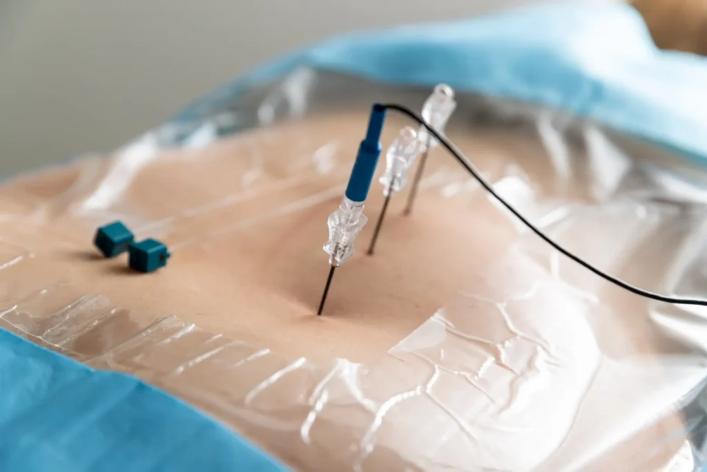 Adjuvante thermale Radiofrequenz Behandlung bei ISSZ AG